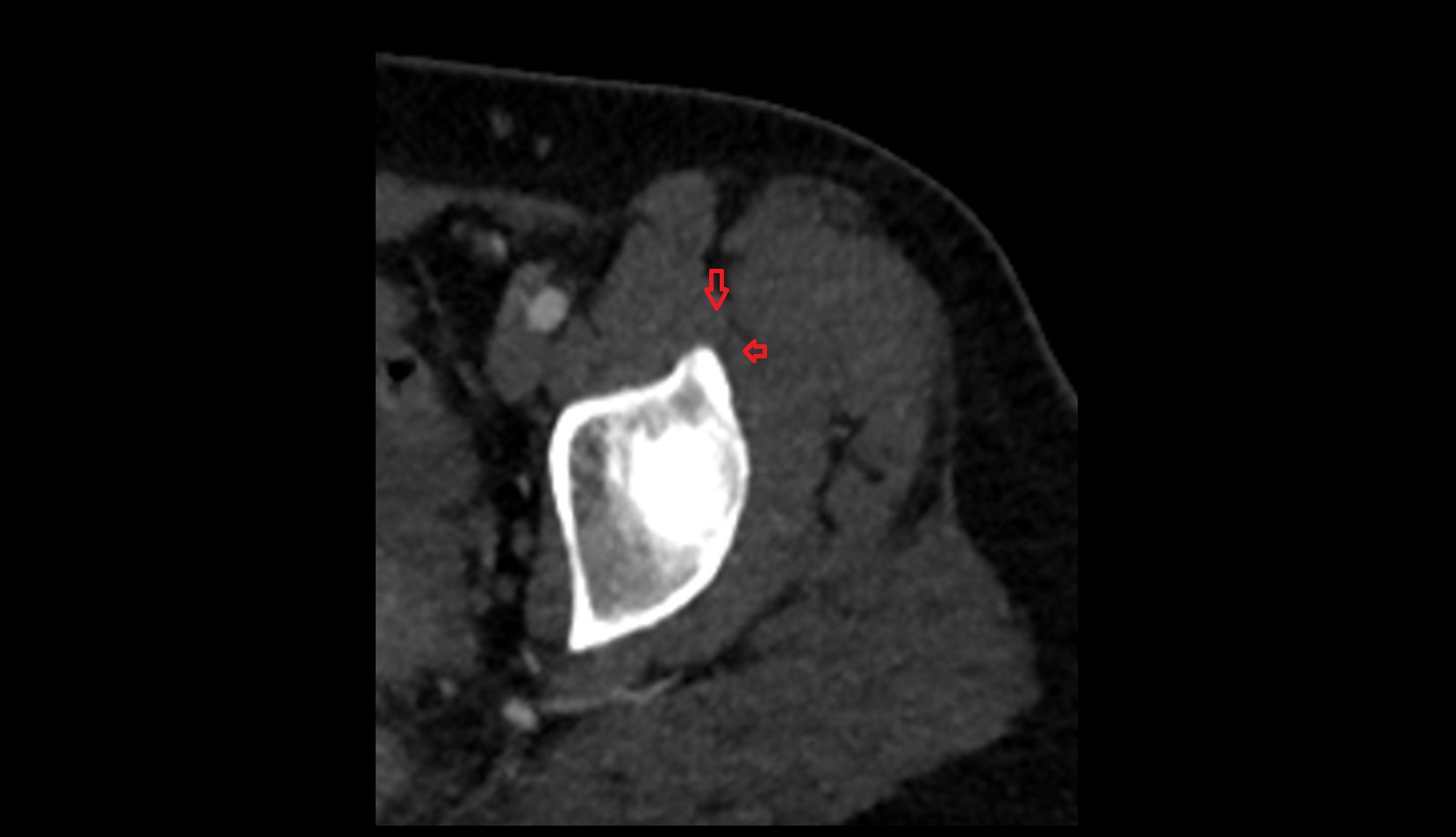 Rectus femoris tendon (Proximal tendon of rectus femoris) ct axial image