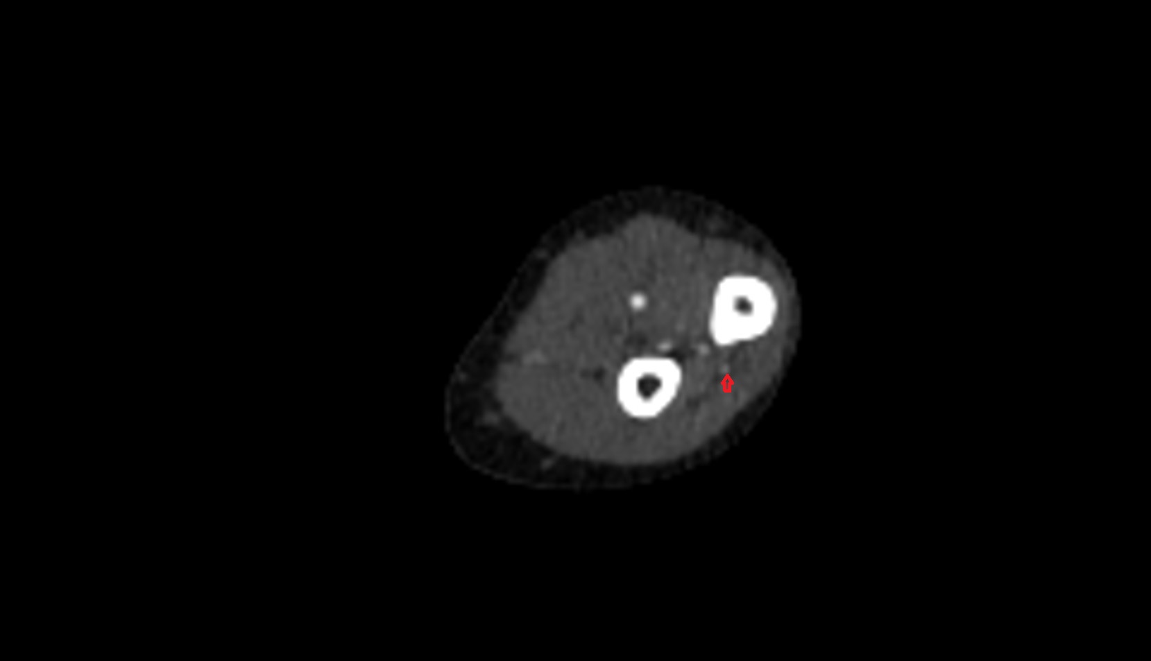 Recurrent interosseous artery CT AXIAL