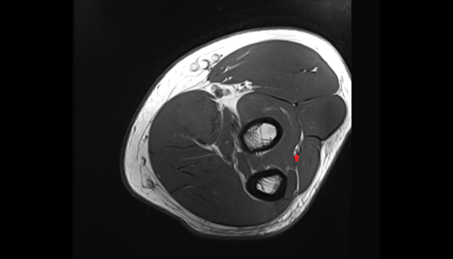 Recurrent interosseous artery axial cross sectional anatomy 3T MRI AI enhanced radiology image -img-00000-00000_00001