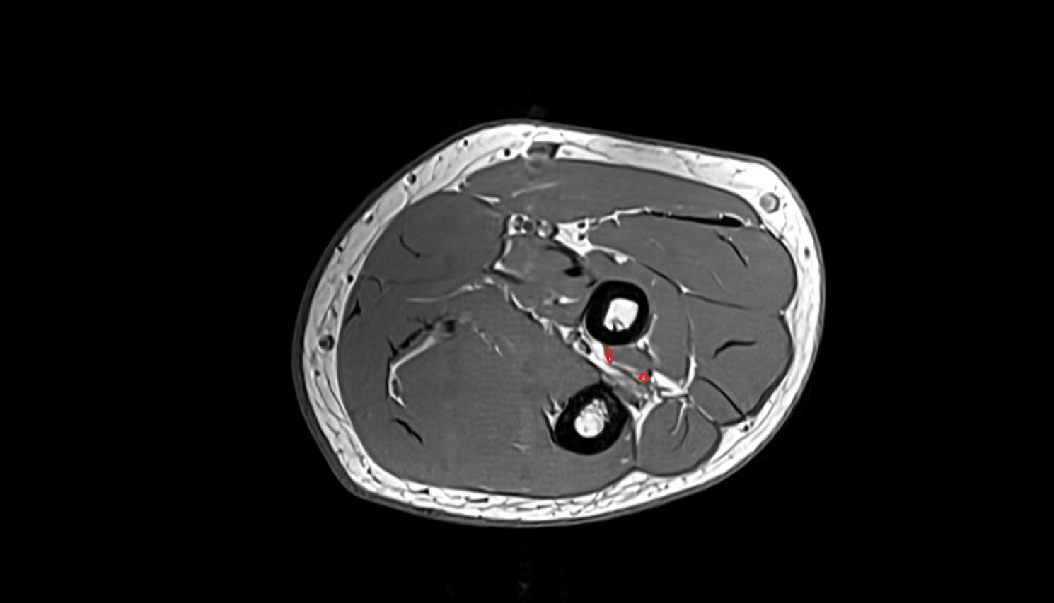 Recurrent interosseous artery axial cross sectional anatomy 3T MRI AI enhanced radiology image -img-00000-00000_00002