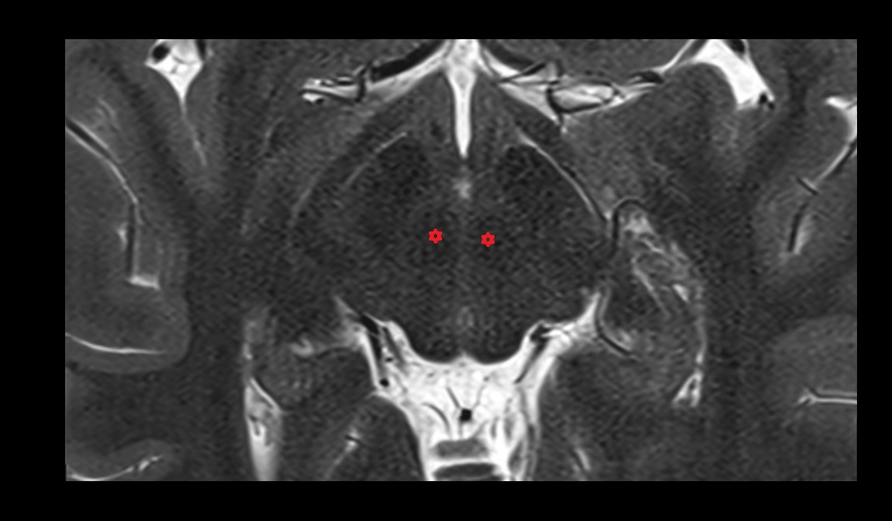 Red nucleus mri 3t axial image