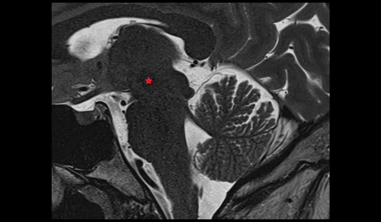 Red nucleus mri 3t sagittal image