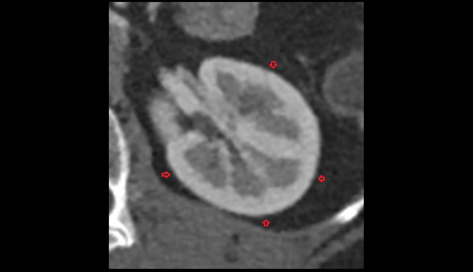 Renal capsule  CT axial  image anatomy  image