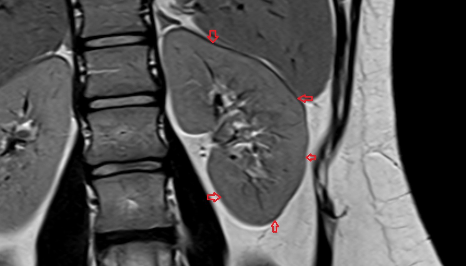 Renal capsule  MRI coronal  image anatomy  image -img-00000-00000