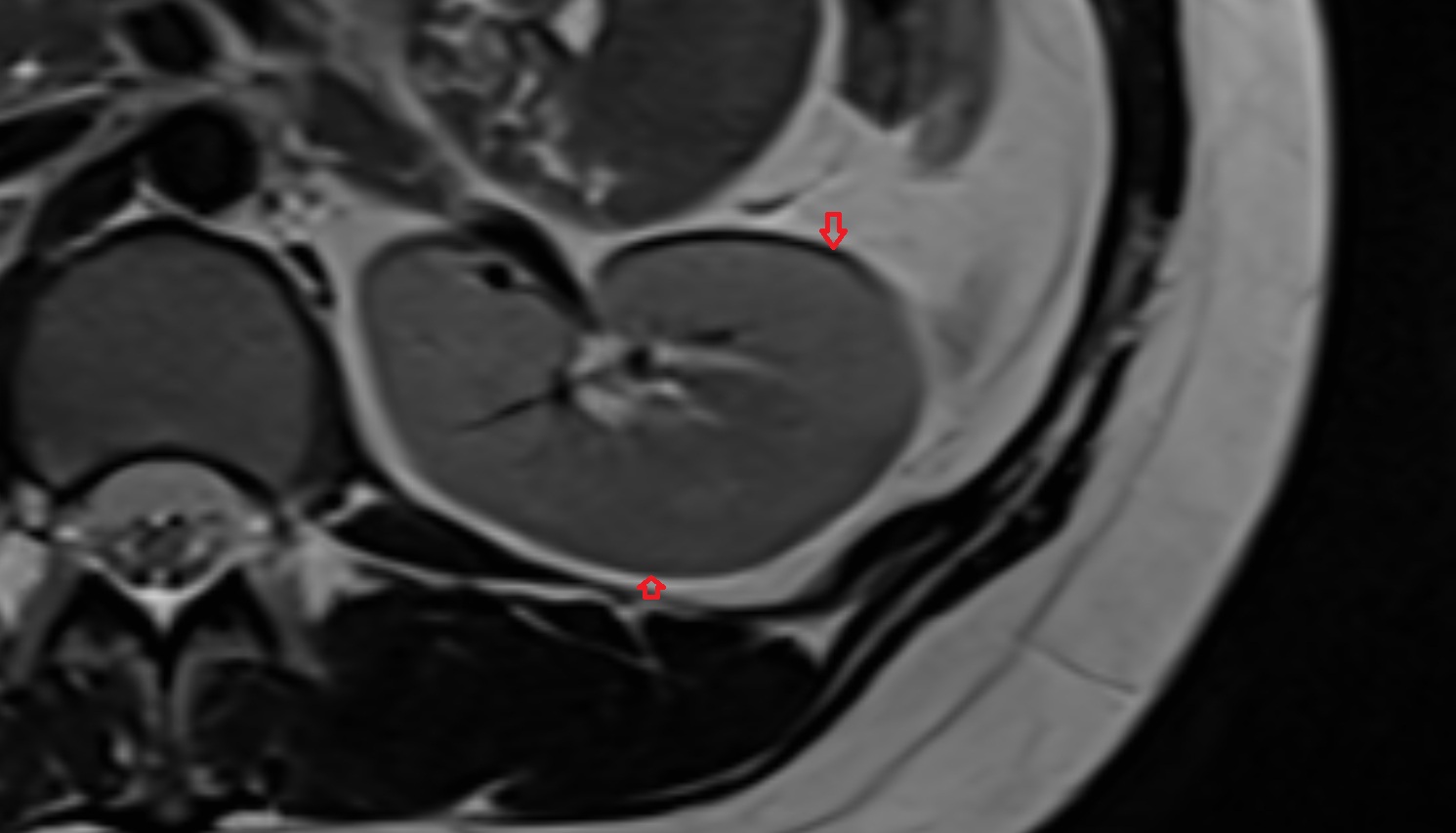 Renal capsule  MRI  image anatomy  image -img-00000-00000