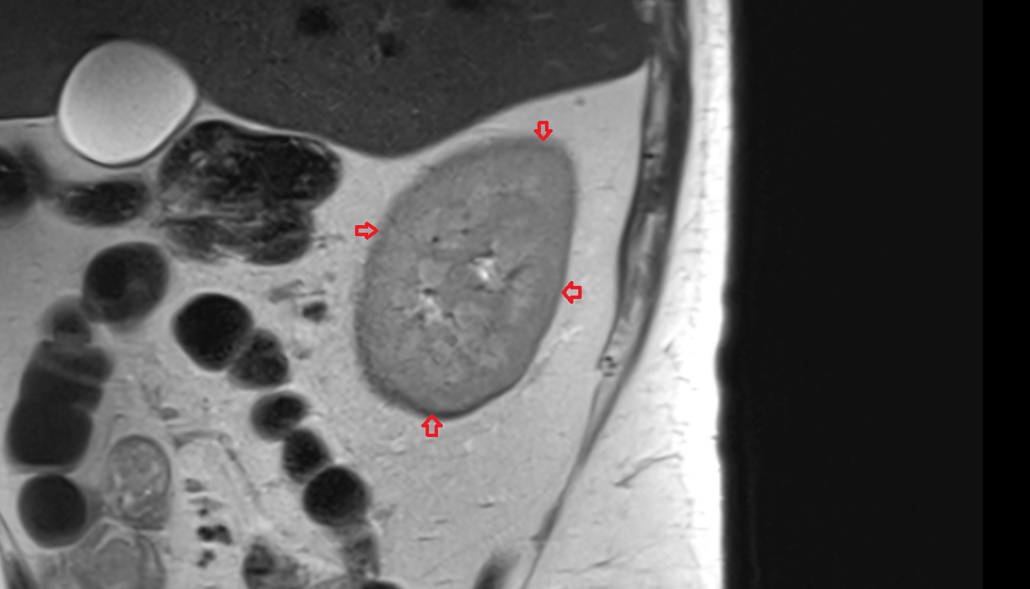 Renal capsule  MRI sag  image anatomy  image -img-00000-00000