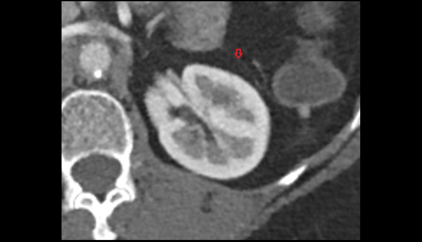 Renal fascia CT axial image