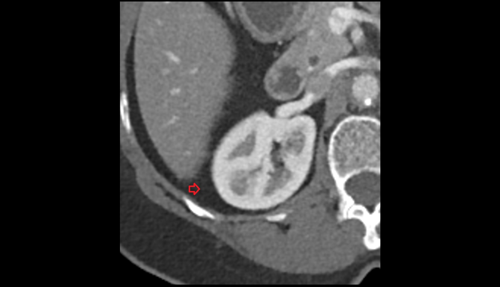 Renal fascia CT axial image 1