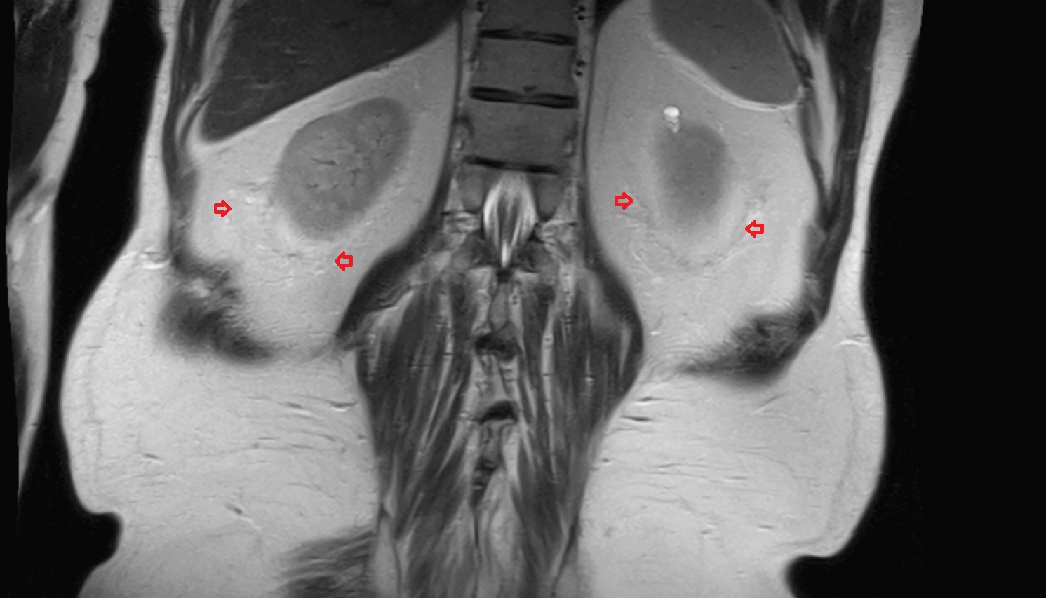 Renal fascia  MRI coronal image anatomy  image -img-00000-00000