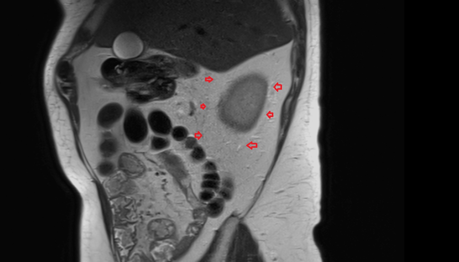 Renal fascia  MRI sag image anatomy  image -img-00000-00000