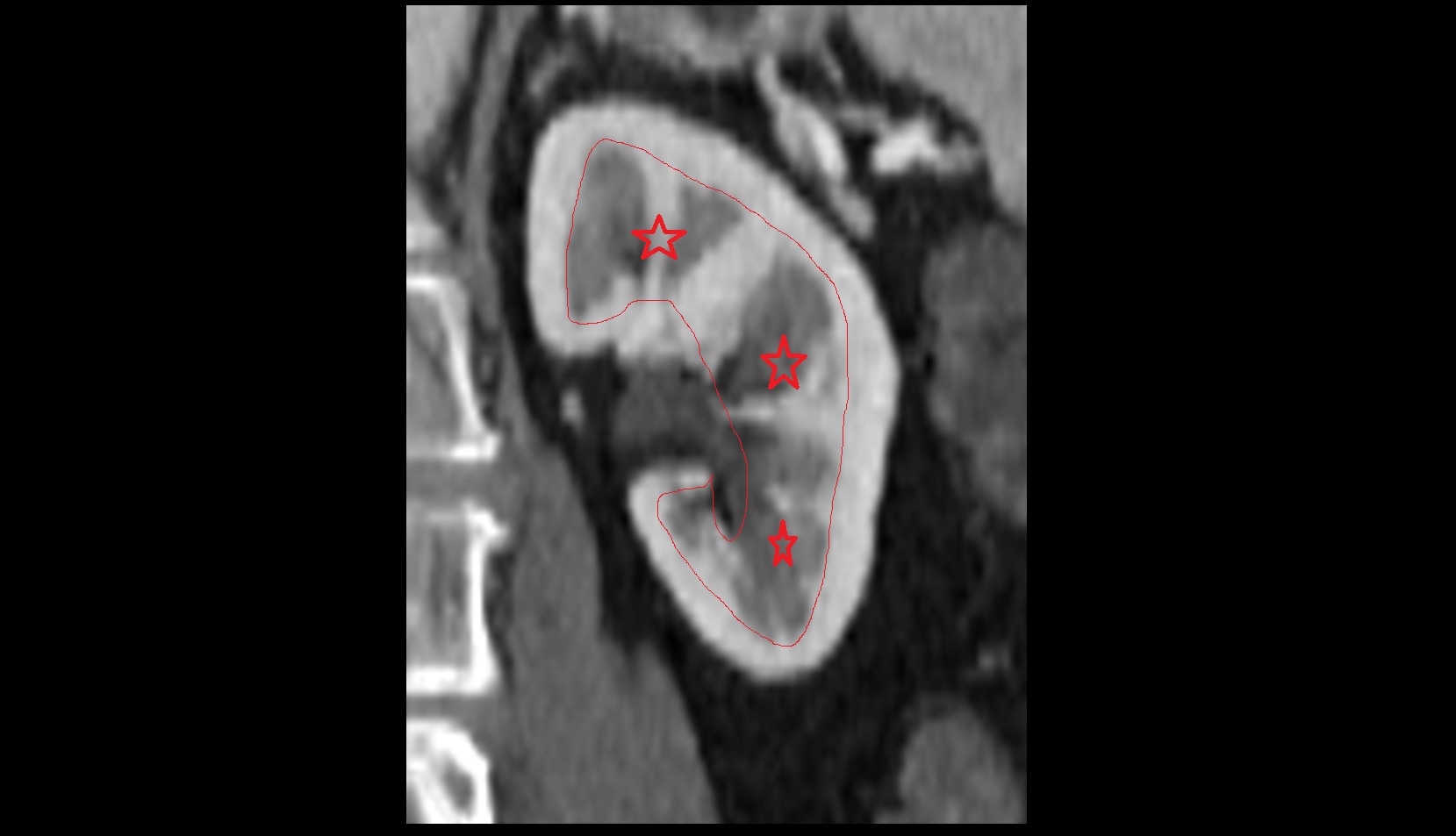 Renal medulla CT coronal image