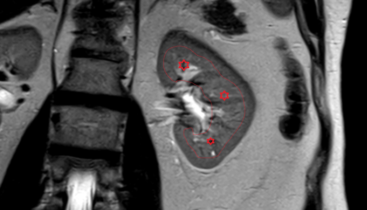 Renal medulla  MRI coronal  image anatomy  image -img-00000-00000