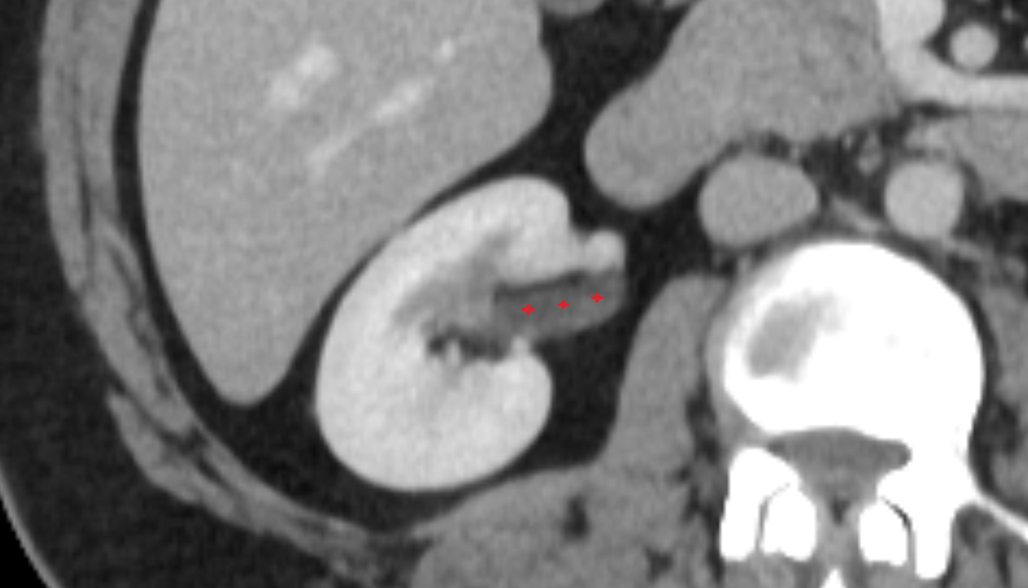 Renal pelvis  CT  AXIAL anatomy  image-img-00000-00000