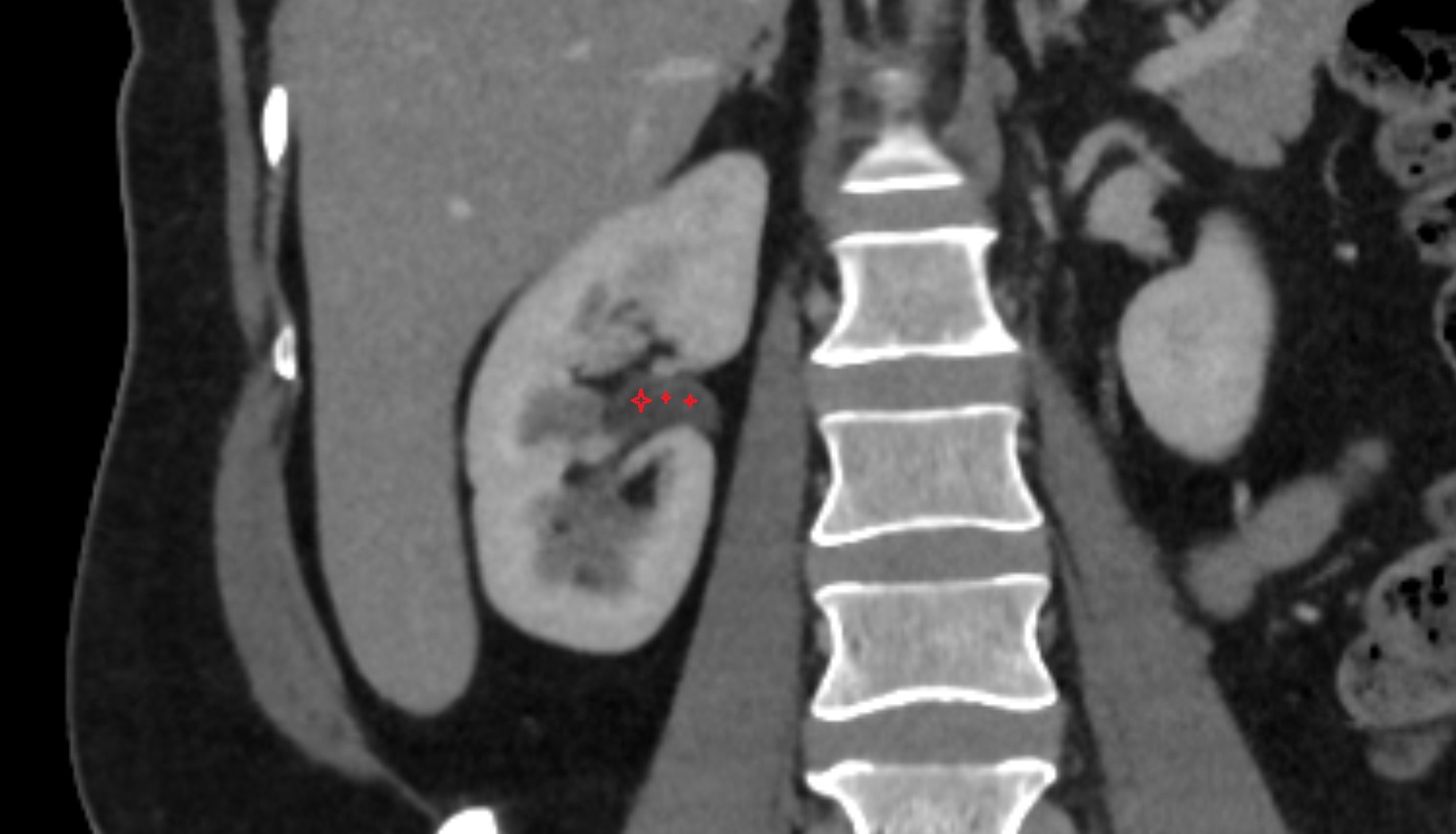 Renal pelvis  CT  coronal  anatomy  image-img-00000-00000