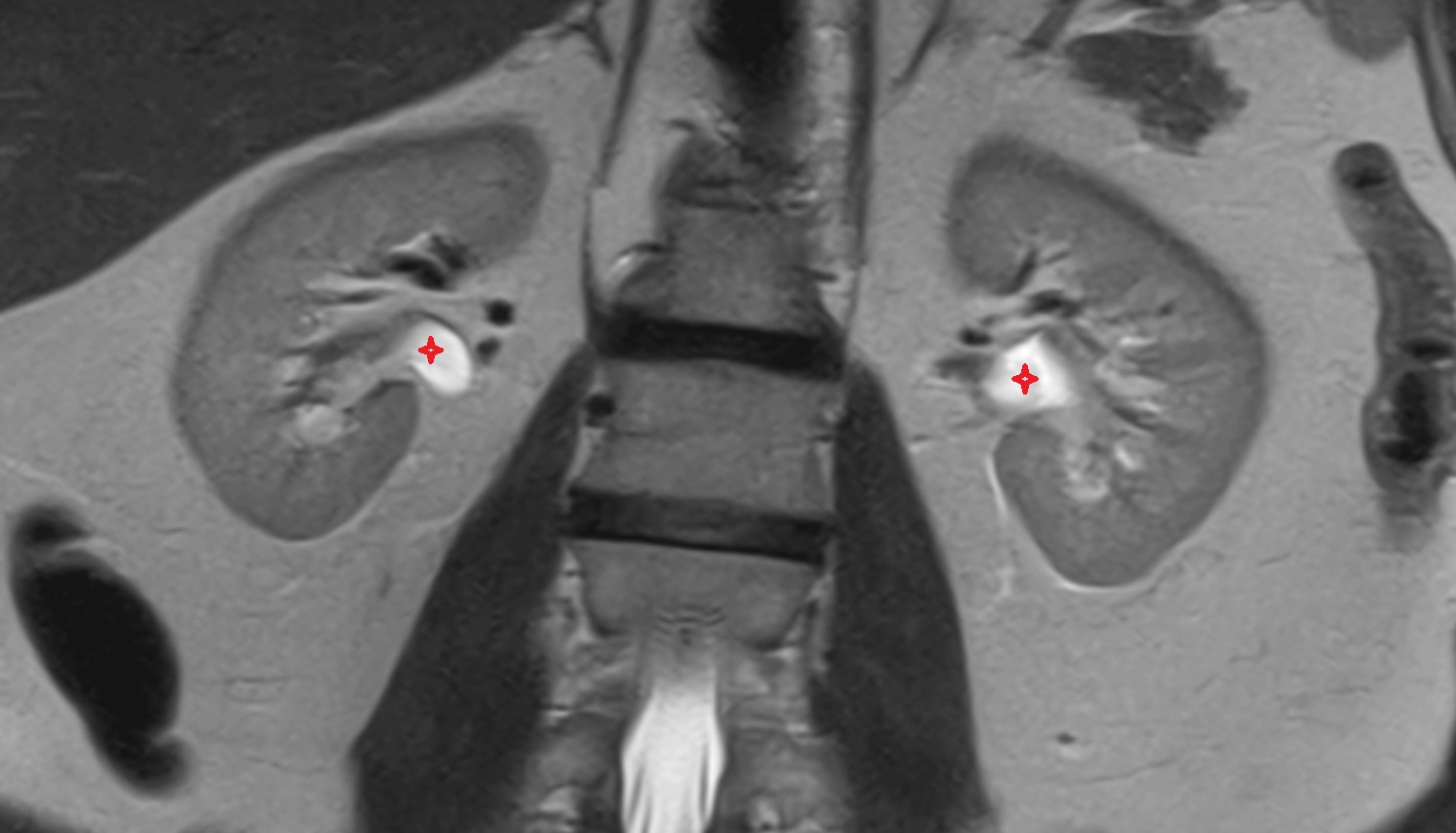 Renal pelvis  mri  coronal  anatomy  image-img-00000-00000