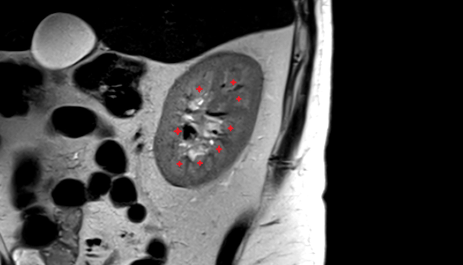 Renal pyramids  MRI sag  image anatomy  image -img-00000-00000