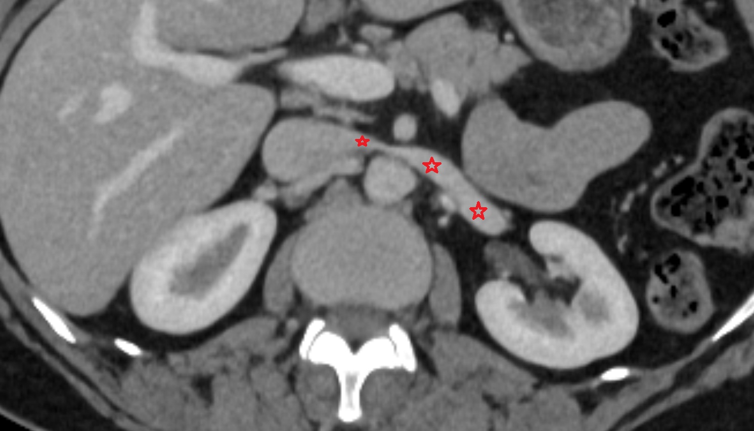 Renal vein  CT AXIAL image anatomy  image -img-00000-00000