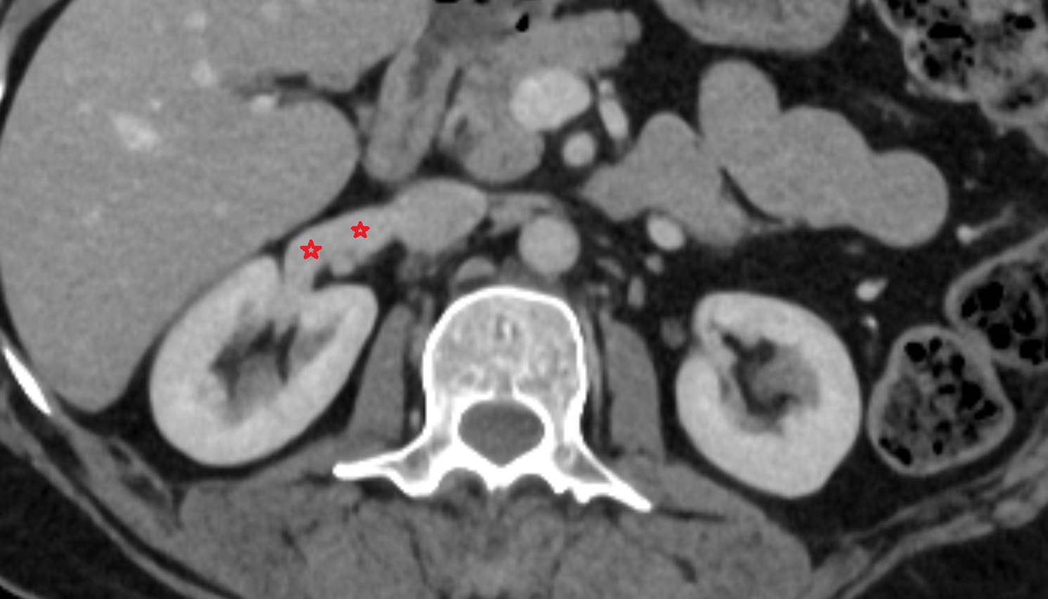 Renal vein  CT AXIAL image anatomy  image -img-00000-00000_00001