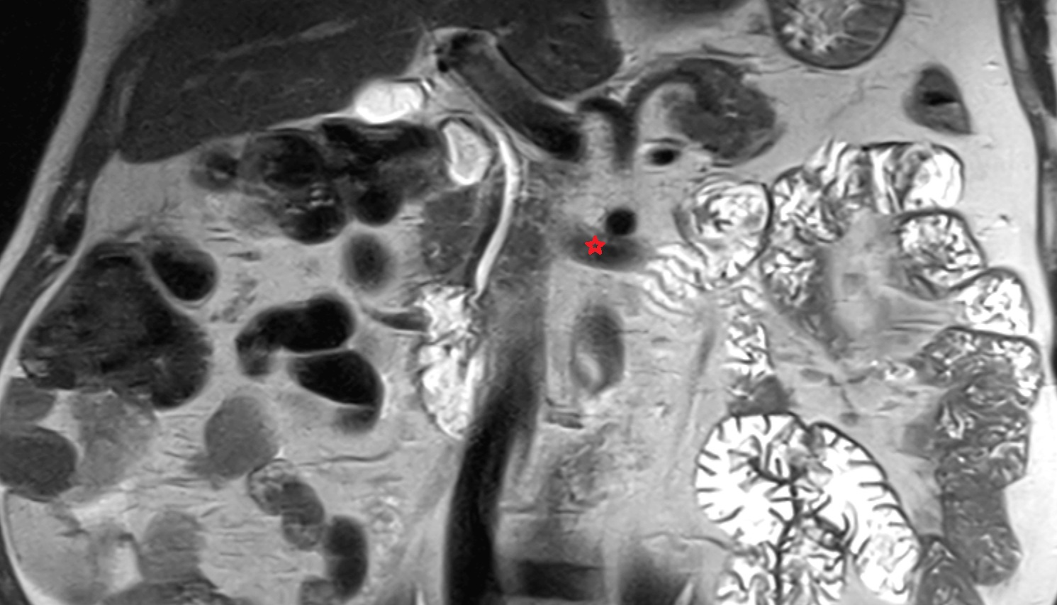 Renal vein  MRI coronal image anatomy  image -img-00000-00000
