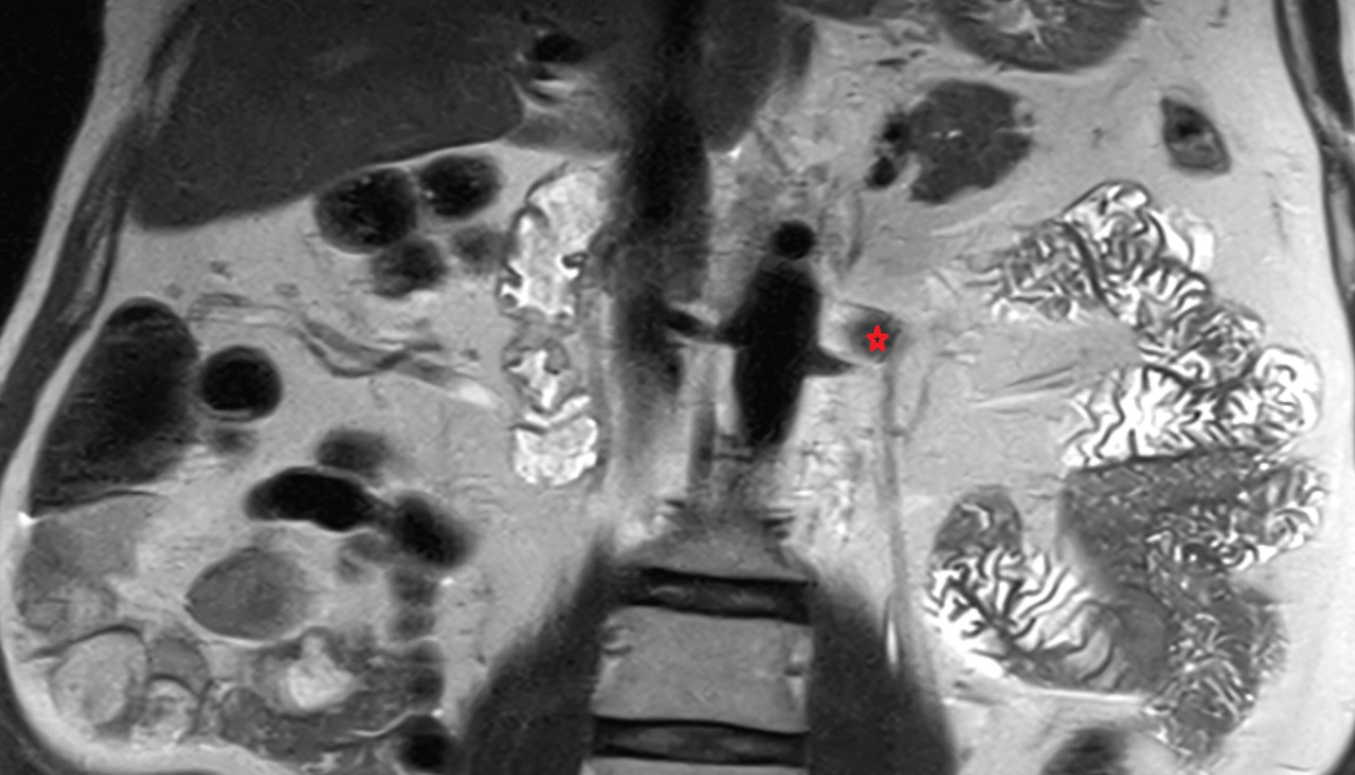 Renal vein  MRI coronal image anatomy  image -img-00000-00000_00001