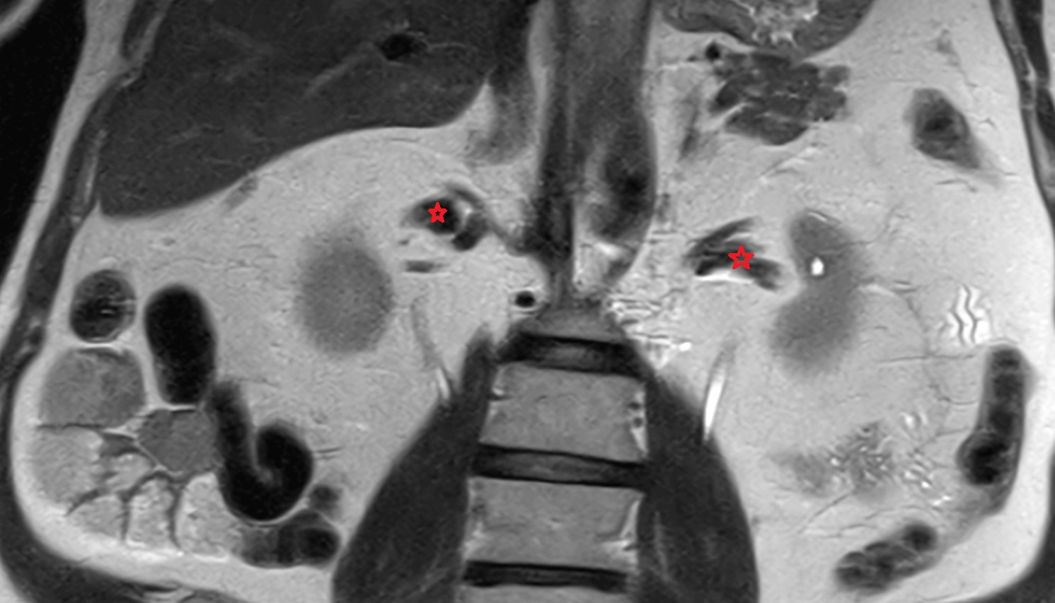 Renal vein  MRI coronal image anatomy  image -img-00000-00000_00002