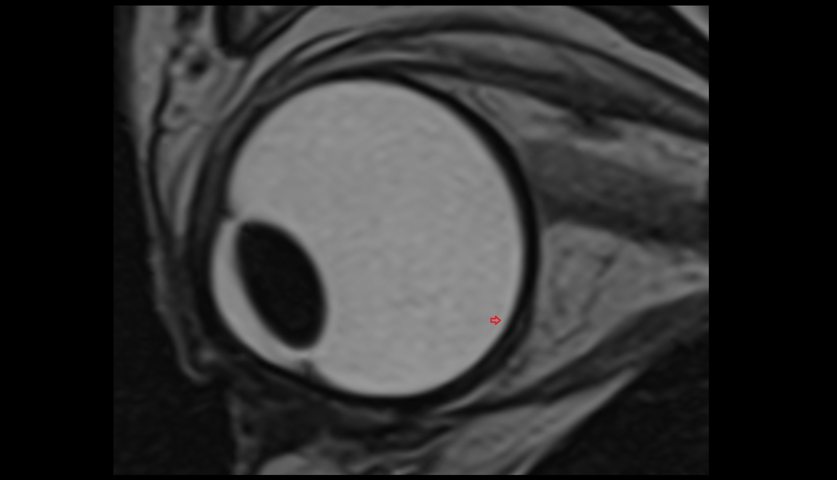 Retina mri t2 sagittal image