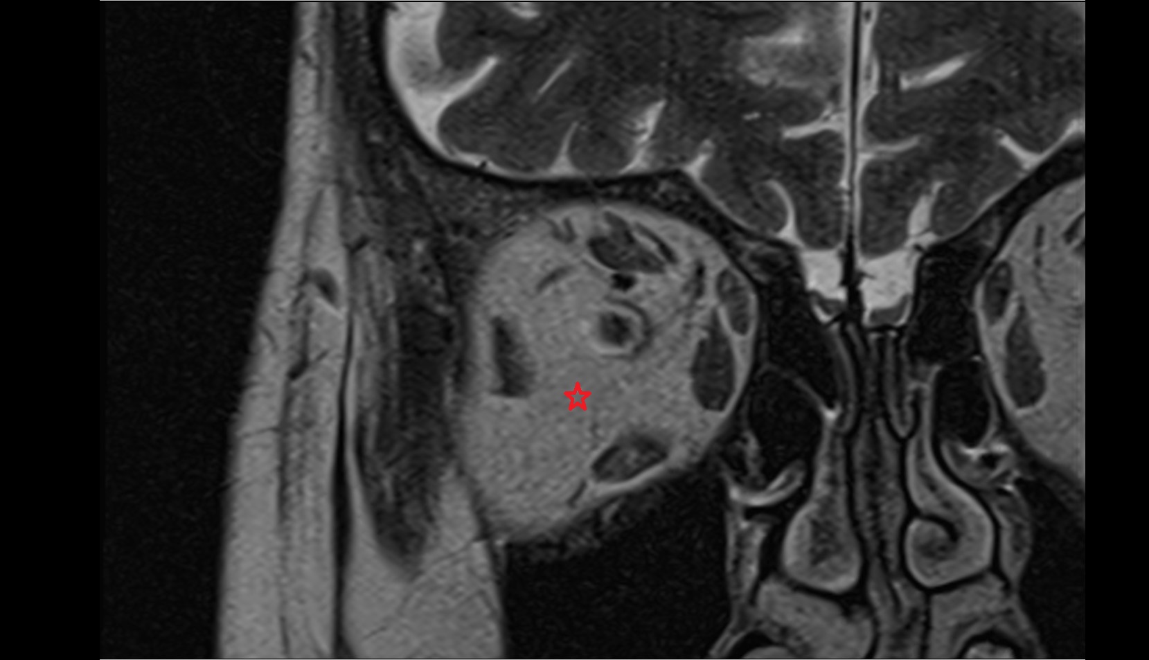 Retrobulbar fat mri image
