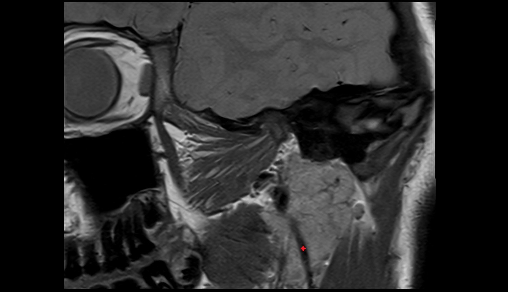 Retromandibular vein mri image
