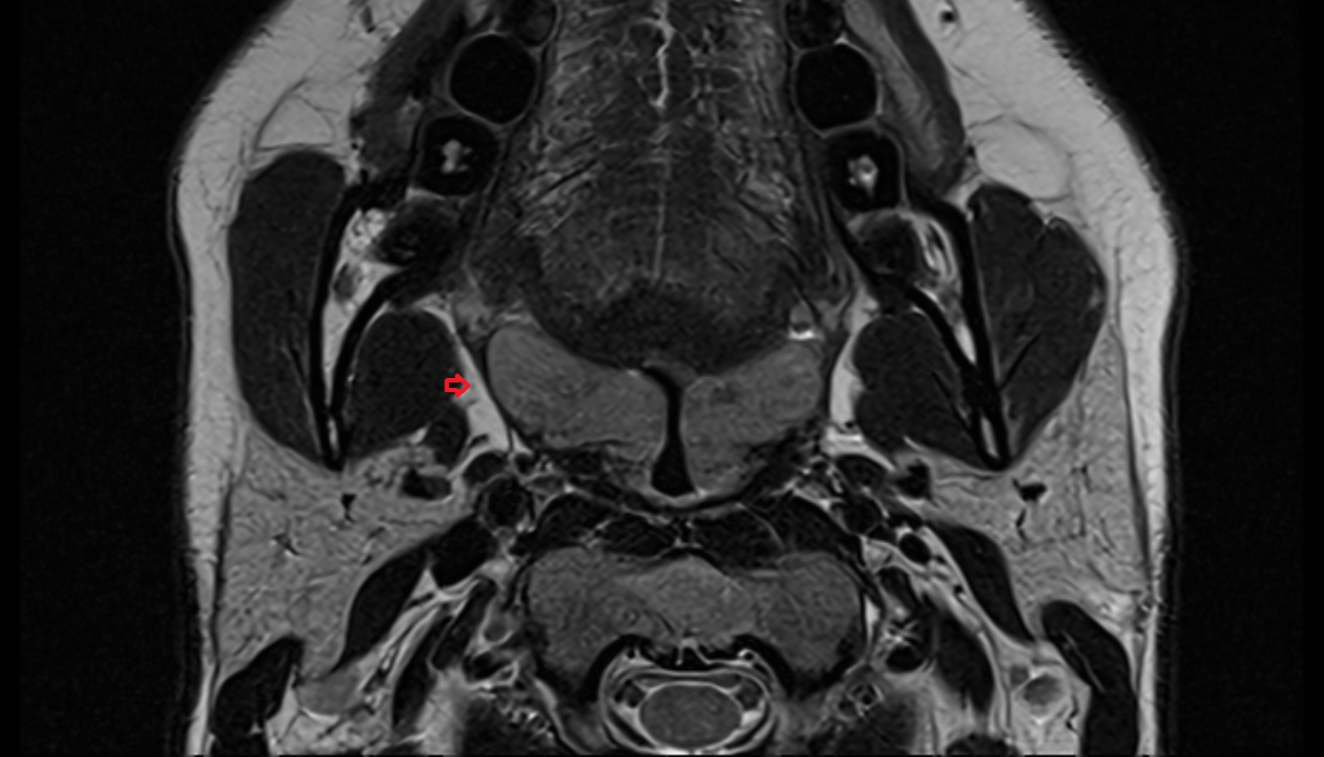 Retropharyngeal lymph nodes  mri axial  image -img-00000-00000