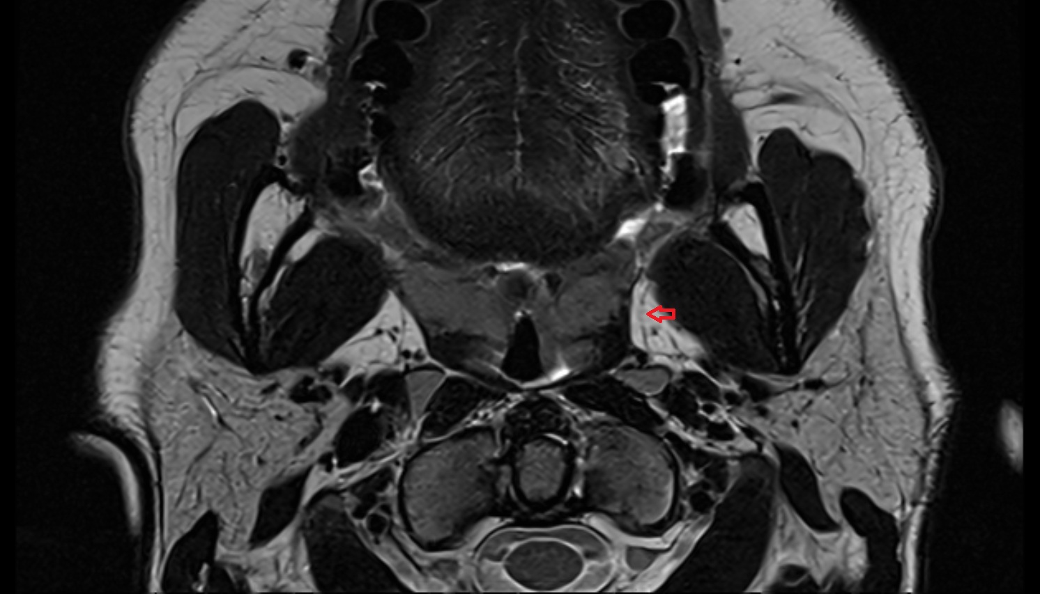 Retropharyngeal lymph nodes  mri axial  image -img-00000-00000_00001