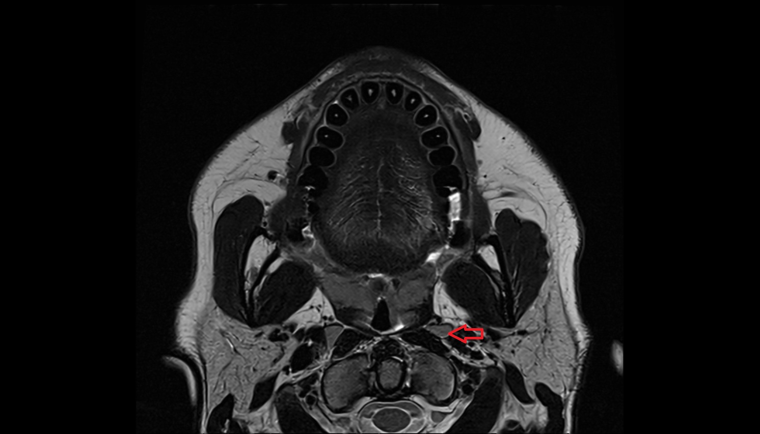 Retropharyngeal lymph nodes  mri axial  image -img-00000-00000_00002