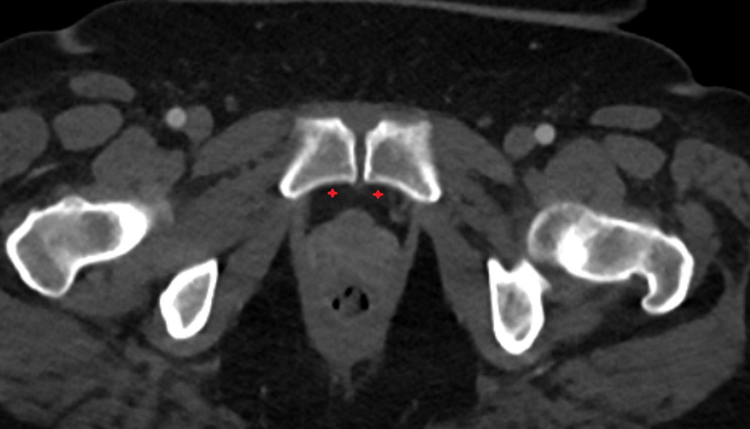 Retropubic space  ct  axial anatomy  image-img-00000-00000