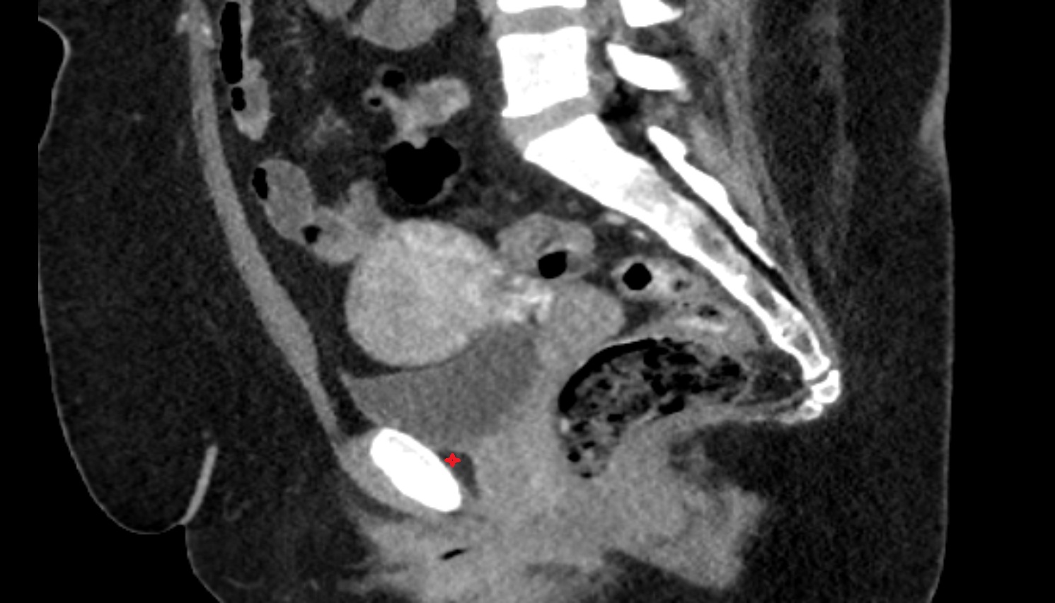 Retropubic space  ct sag anatomy  image-img-00000-00000