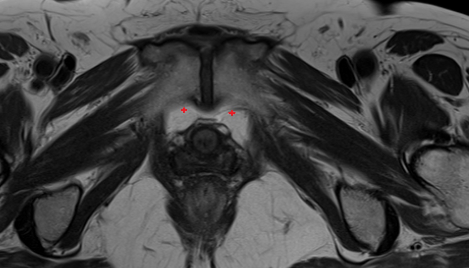 Retropubic space  mri axial  anatomy  image-img-00000-00000