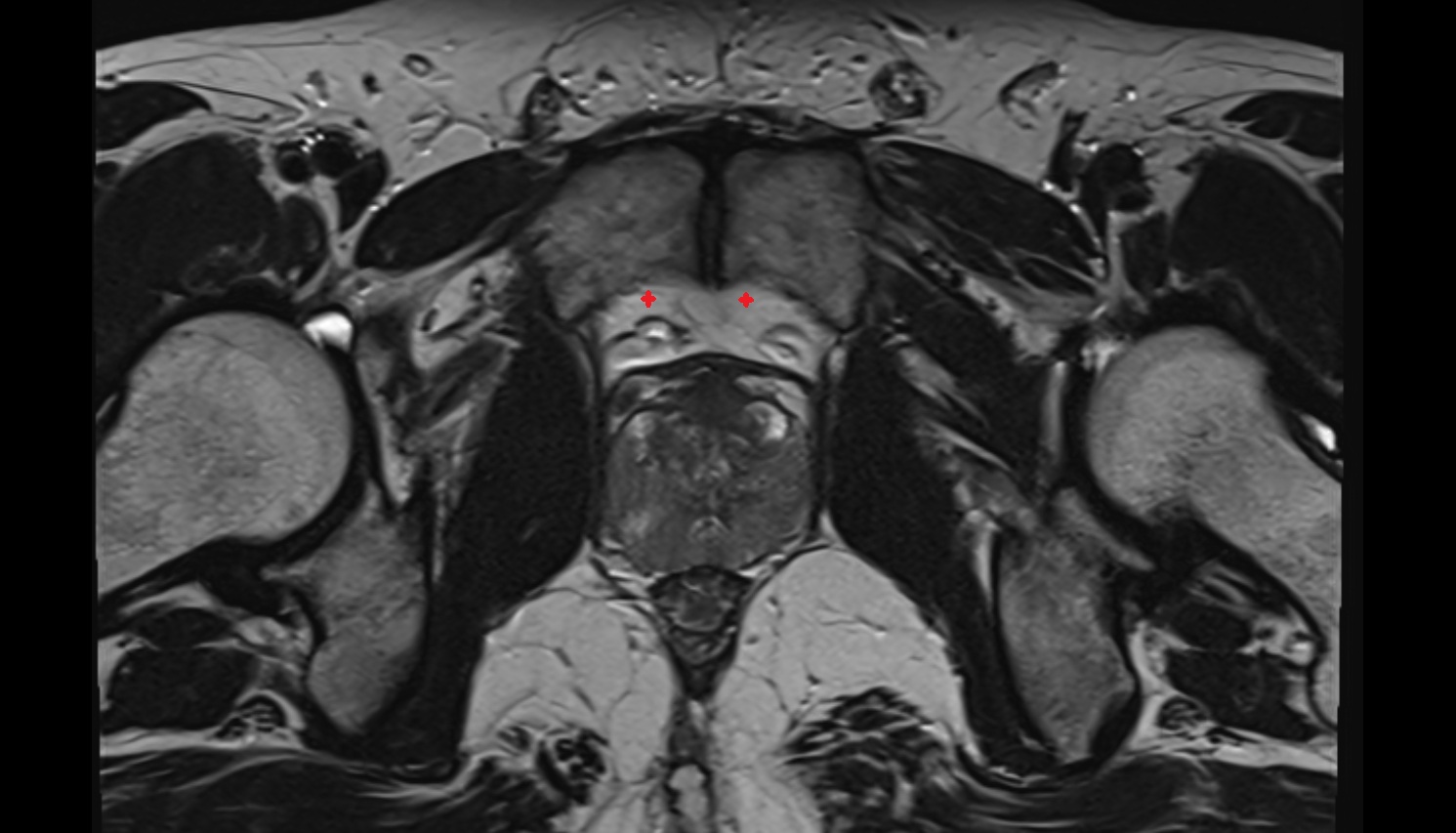 Retropubic space  mri axial  anatomy  image-img-00000-00000_00001