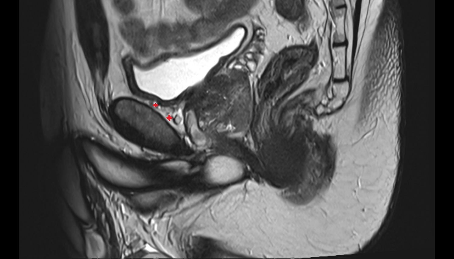 Retropubic space  mri sag  anatomy  image-img-00000-00000