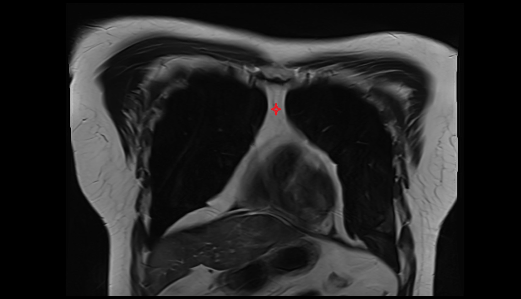 Retrosternal space coronal mri image