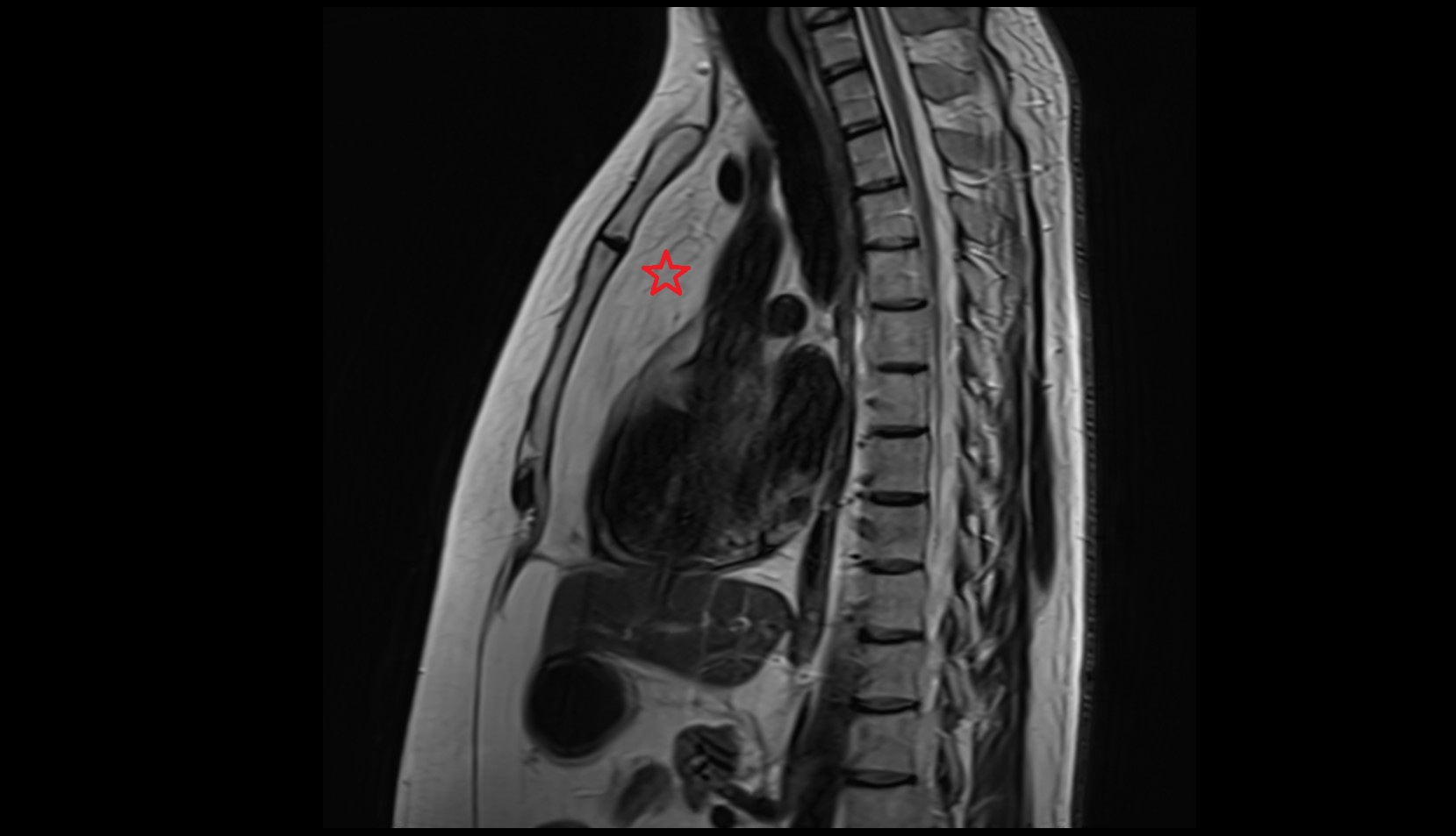 Retrosternal space mri sagittal image