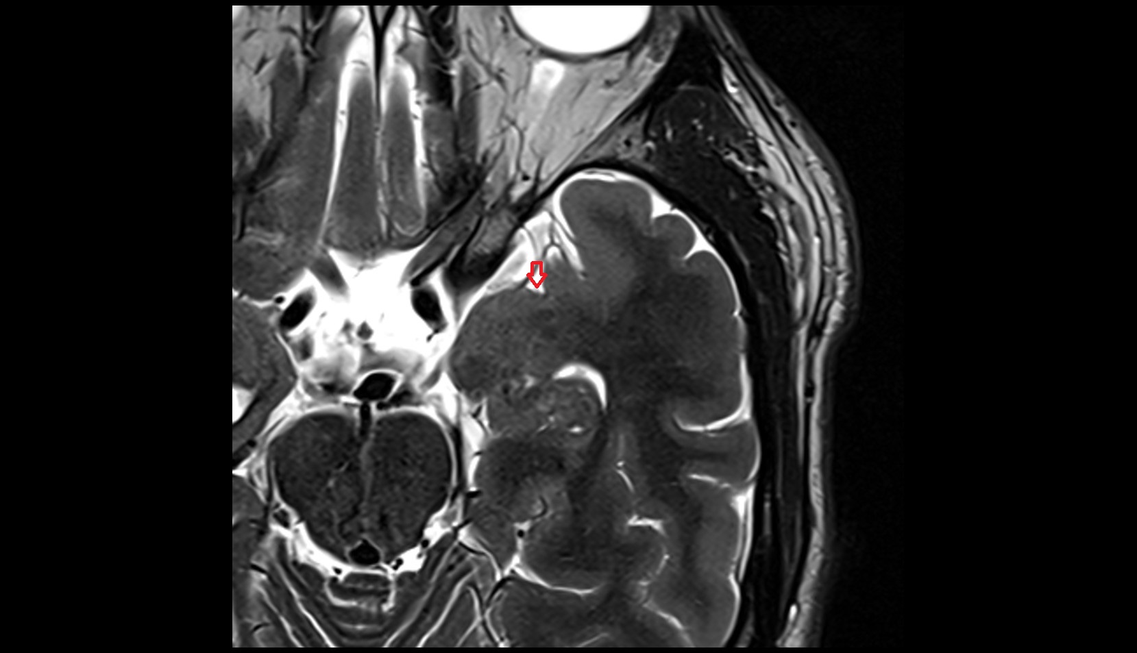 Rhinal sulcus MRI 3T axial image