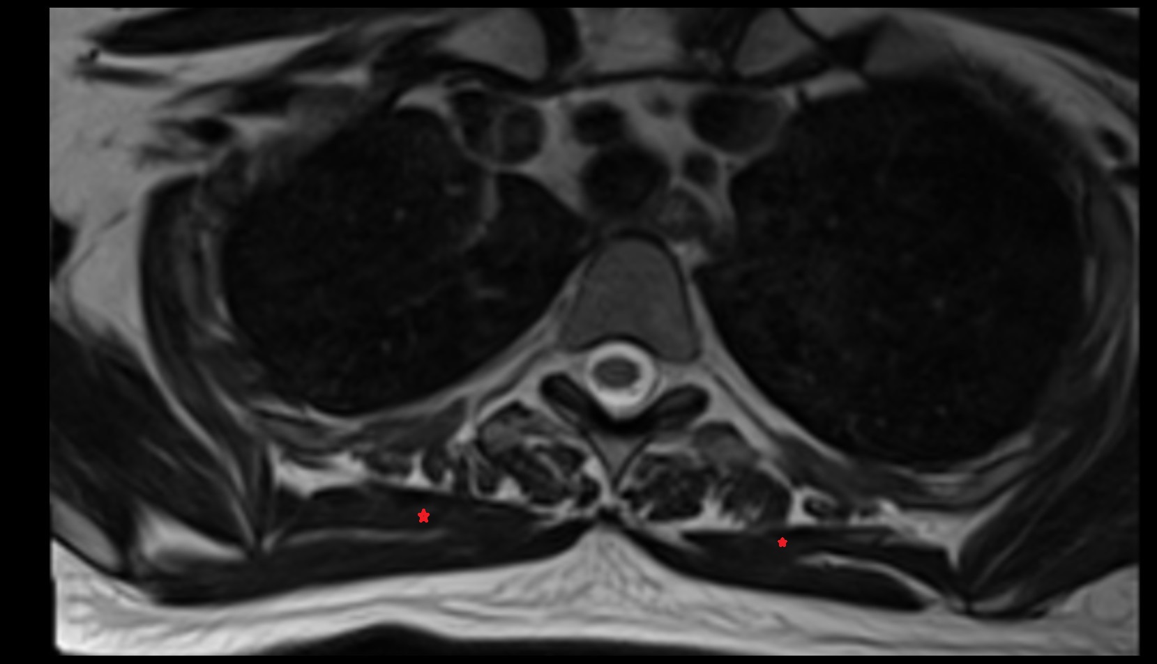 Rhomboid major muscle MRI image