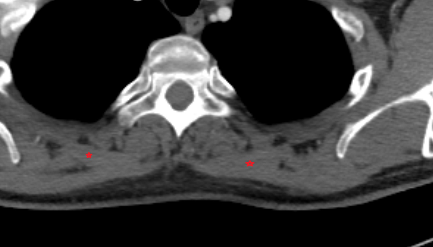 Rhomboid major muscle anatomy MRI  axial  image -img-00000-00000