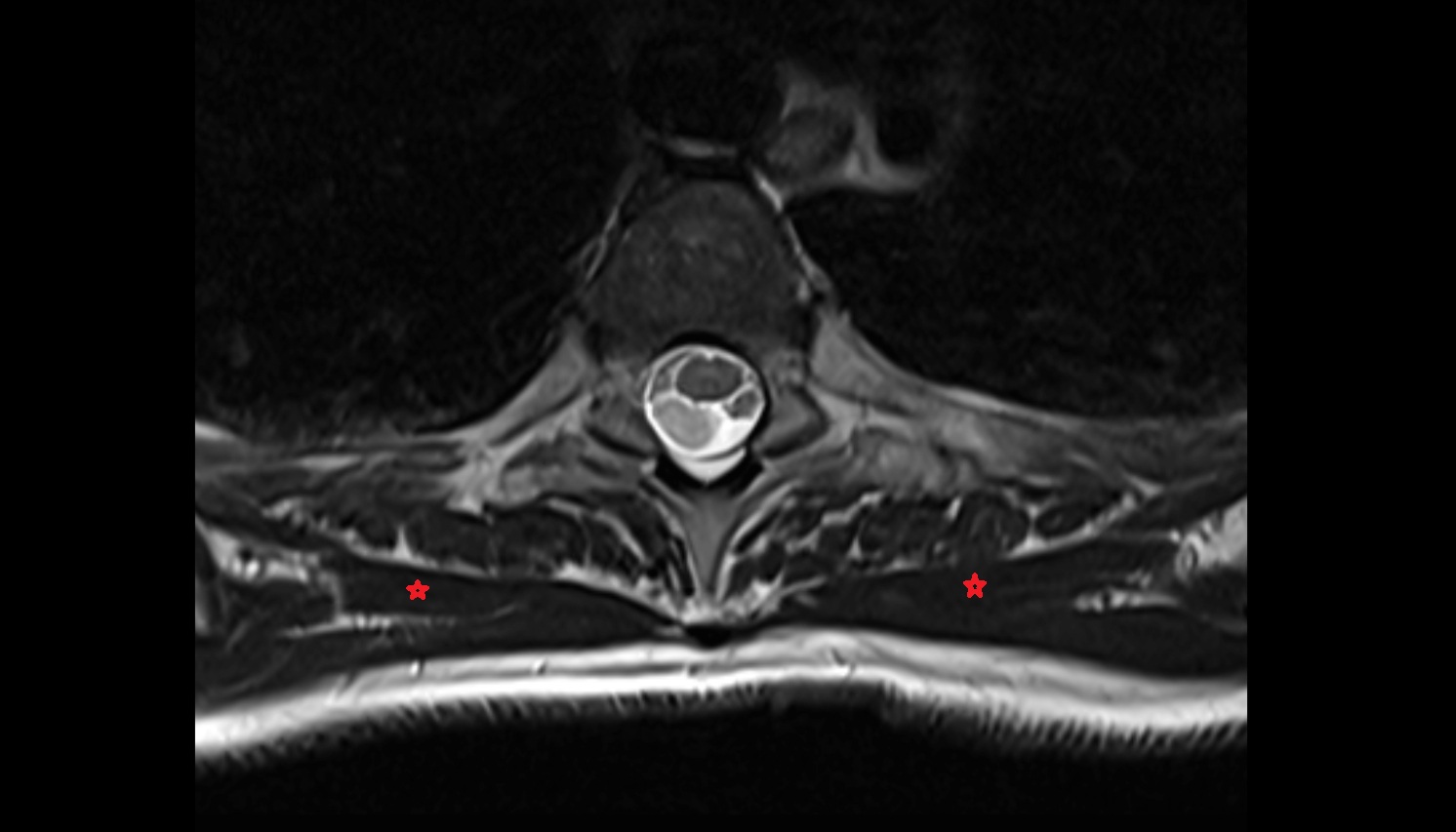 Rhomboid major muscle anatomy MRI  axial  image -img-00000-00000_00001