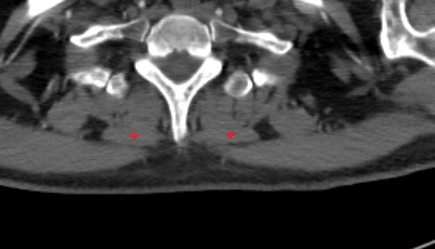 Rhomboid minor muscle anatomy CT axial  image -img-00000-00000