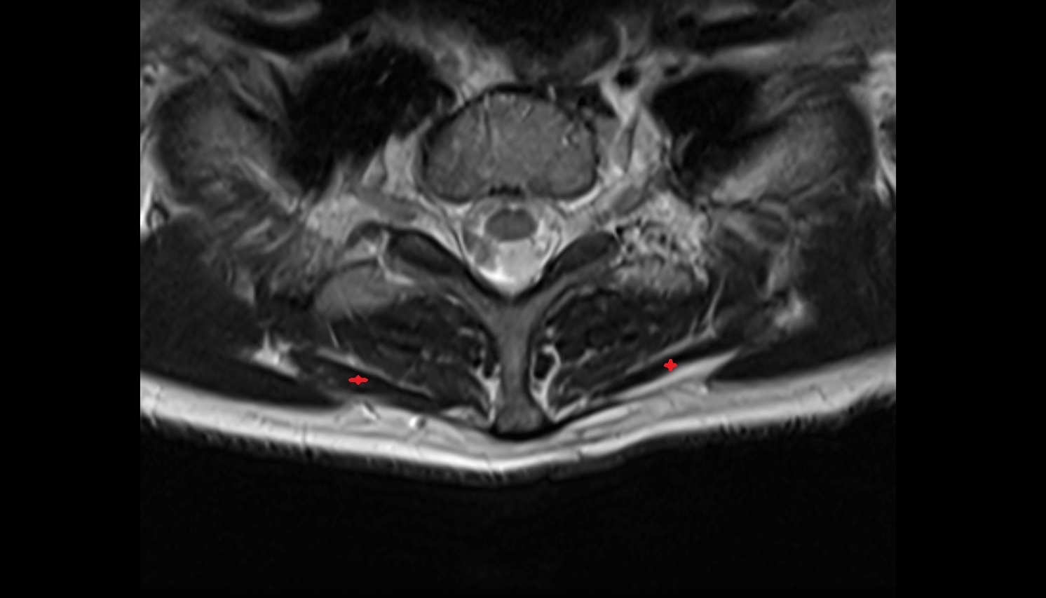 Rhomboid minor muscle anatomy MRI  axial  image -img-00000-00000_00001
