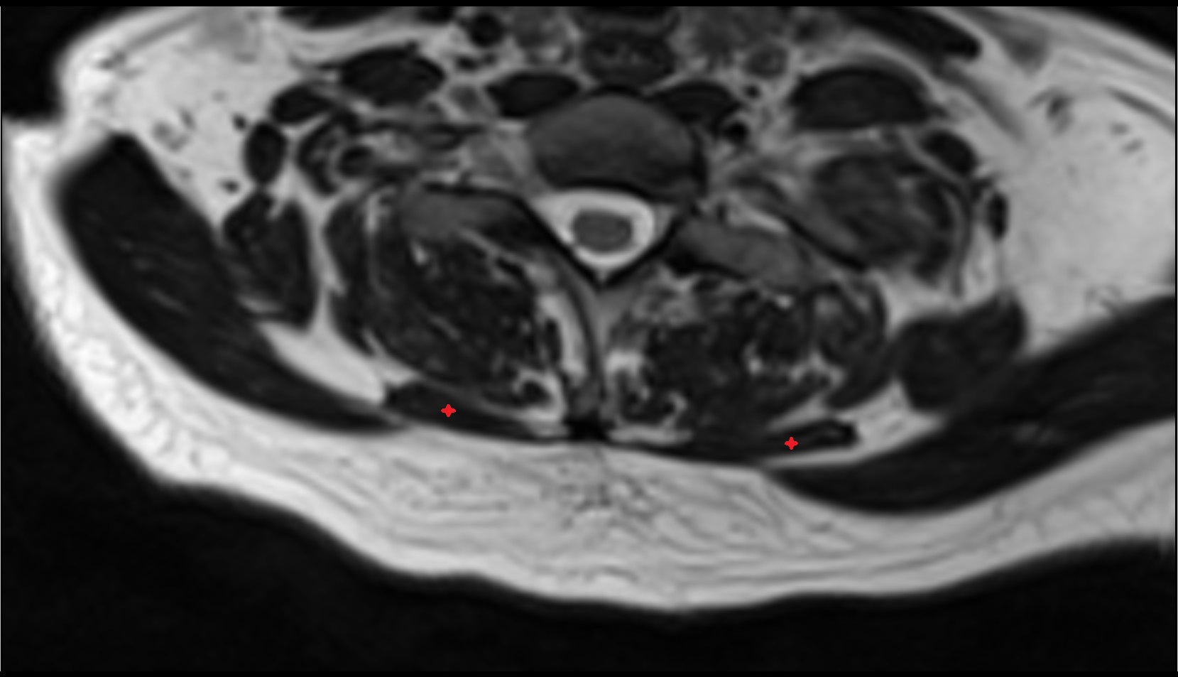 Rhomboid minor muscle axial mri image