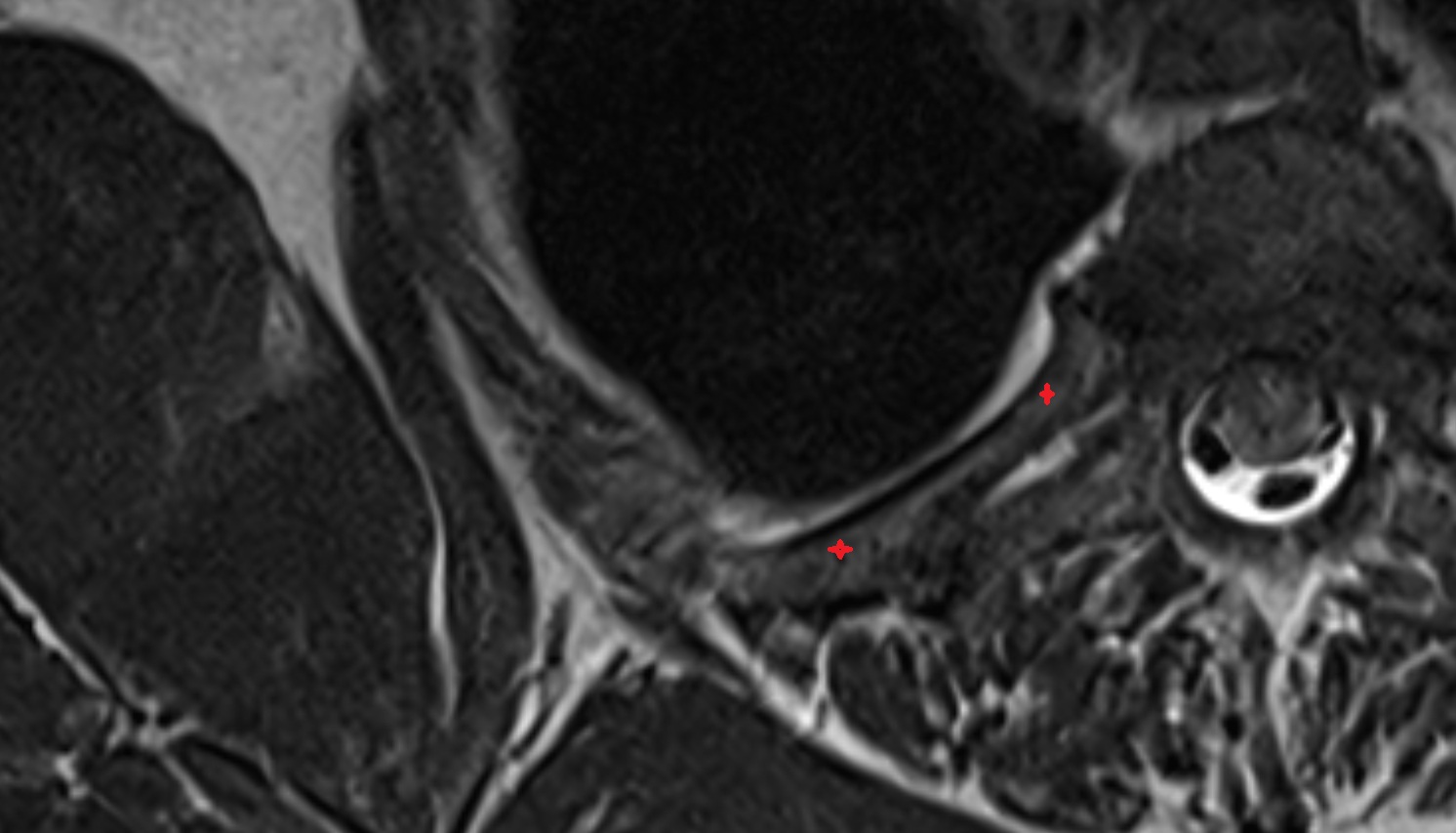Ribs  MRI  axial  image -img-00000-00000