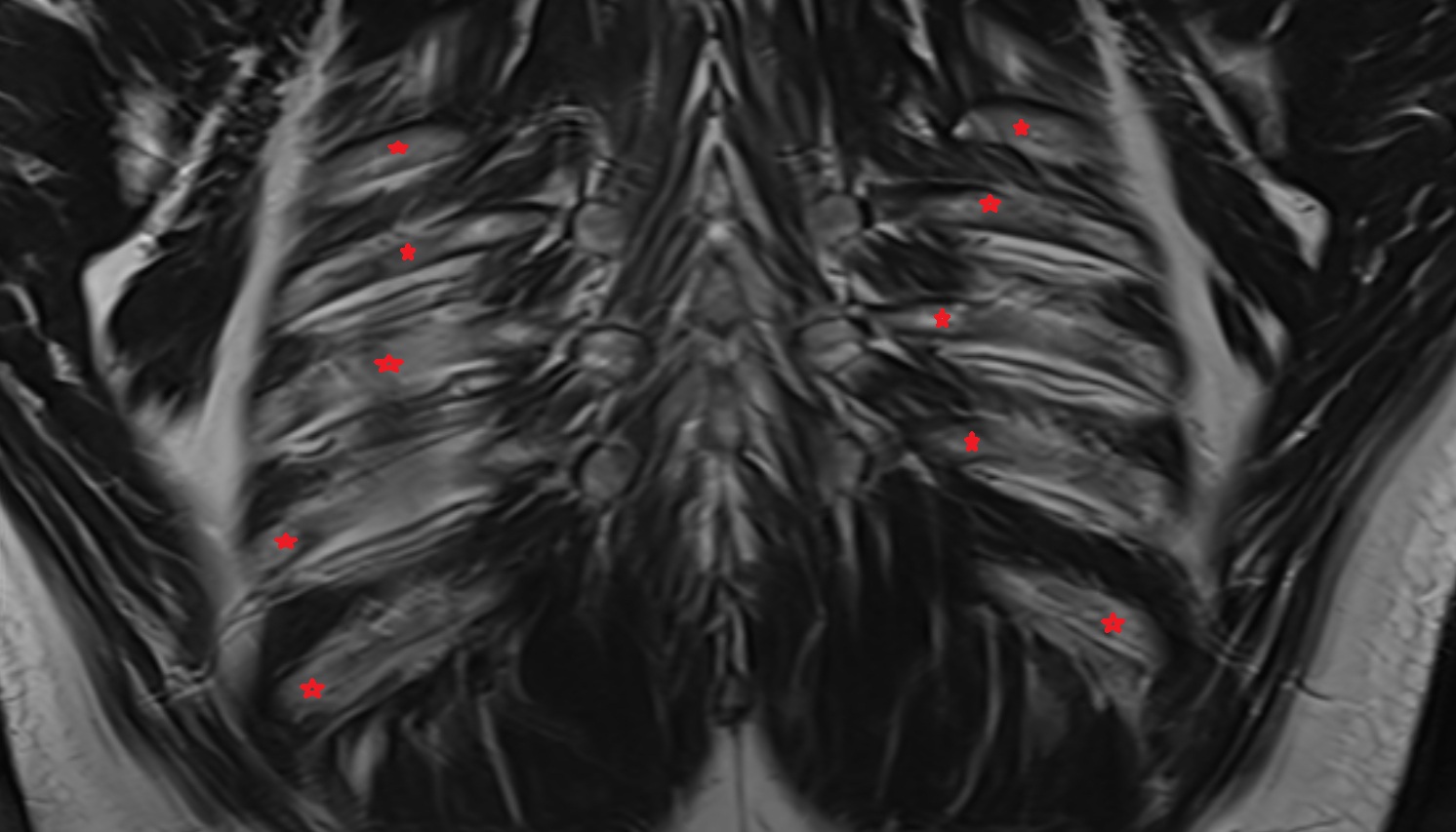 Ribs  MRI  coronal  image -img-00000-00000
