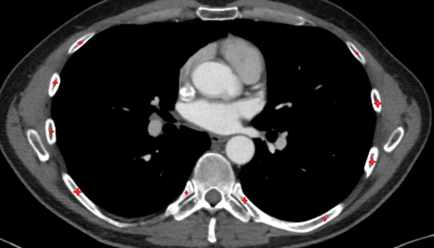 Ribs  anatomy CT axial  image -img-00000-00000