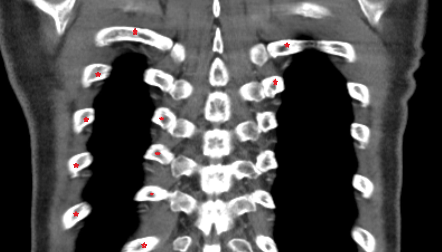 Ribs  anatomy CT coronal  image -img-00000-00000