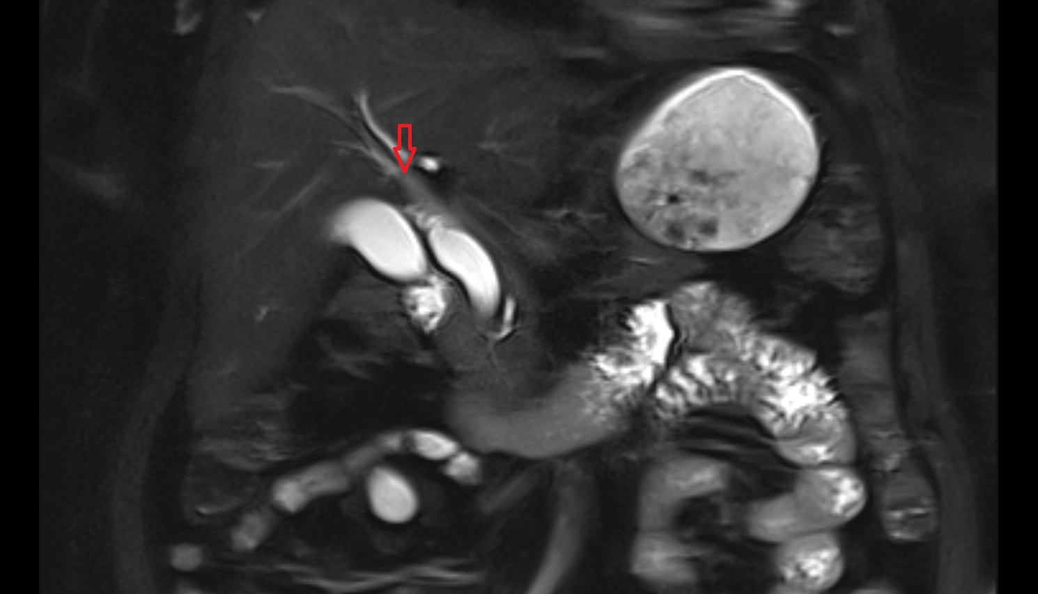 Right Hepatic Duct   mri  coronal  anatomy  image-img-00000-00000